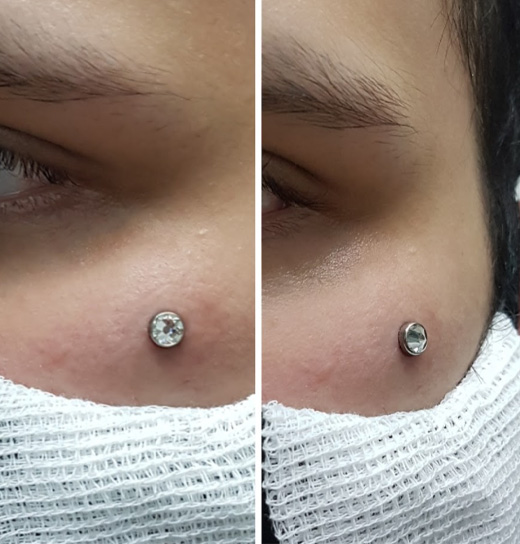 microdermal